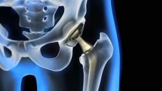 Diabetiker haben öfter schwere Arthrose Diabetiker haben öfter schwere Arthrose