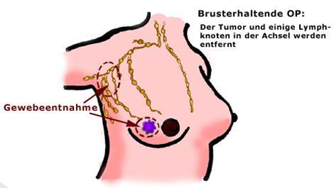 Die Erhöhung der Brust ohne Nähte