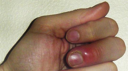 Gribok der Nägel auf den Beinen die Behandlung des Kaffees