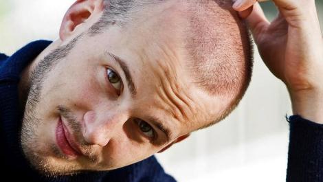 Mann mit Haarausfall, Glatze, Haarausfall, Haare, Mann