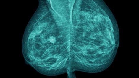 Brustkrebs: Mammografie-Aufnahme einer Brust, Brustkrebs, Mammografie