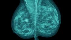 Brustkrebs: Mammografie-Aufnahme einer Brust, Brustkrebs, Mammografie,