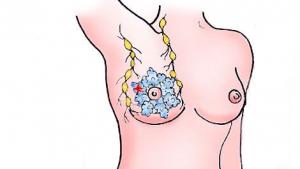 Brustkrebs: Anatomie einer weiblichen Brust, Brustkrebs