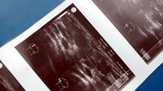 Ultraschallaufnahme der Brust, Brust, Ultraschall